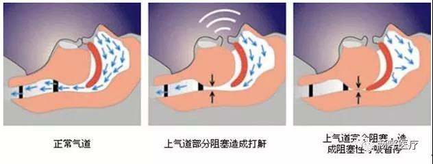我國3000萬高血壓患者都有這毛病！你知道嗎？
